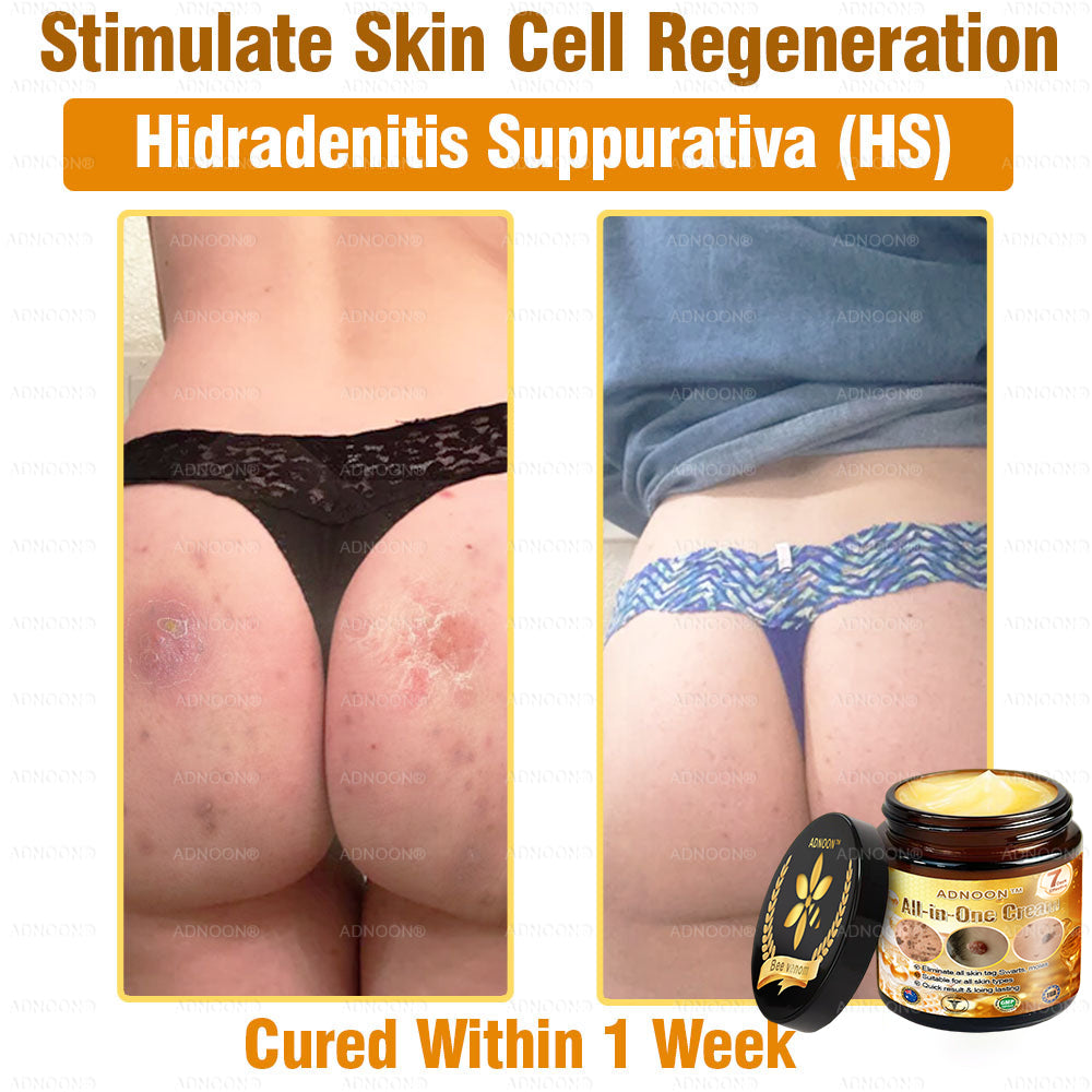 Official Store✅ADNOON®🌸 Multi-Effect All-in-One Skincare Cream👨⚕️ Certified by The Australasian College of Dermatologists (ACD) (Treating Skin Cancer, Eczema, Acne, Warts, Psoriasis, Wrinkles, Scars, and Varicose Veins)