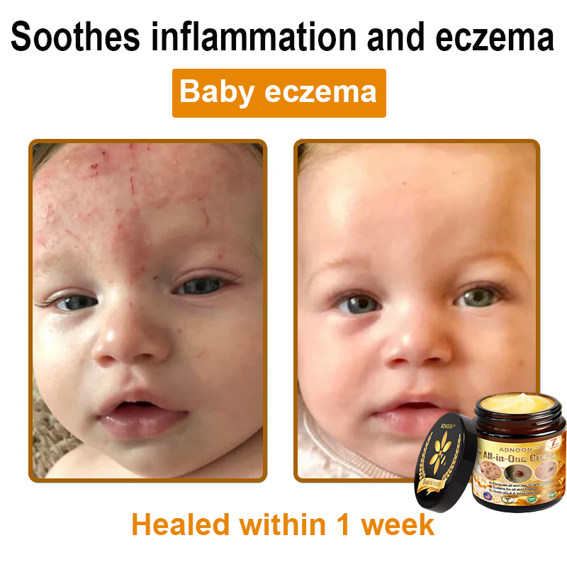 Official Store✅ADNOON®🌸 Multi-Effect All-in-One Skincare Cream👨⚕️ Certified by The Australasian College of Dermatologists (ACD) (Treating Skin Cancer, Eczema, Acne, Warts, Psoriasis, Wrinkles, Scars, and Varicose Veins)
