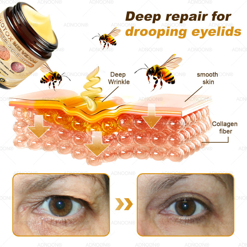 Mayo Clinic Official: 🐝ADNOON®Botox Skin Treatment Cream Anti-aging, Hydrating, Skin Repair, Even Tone, Acne and Dark Spot Treatment, Wart and Mole Removal, Psoriasis Relief🧑⚕️