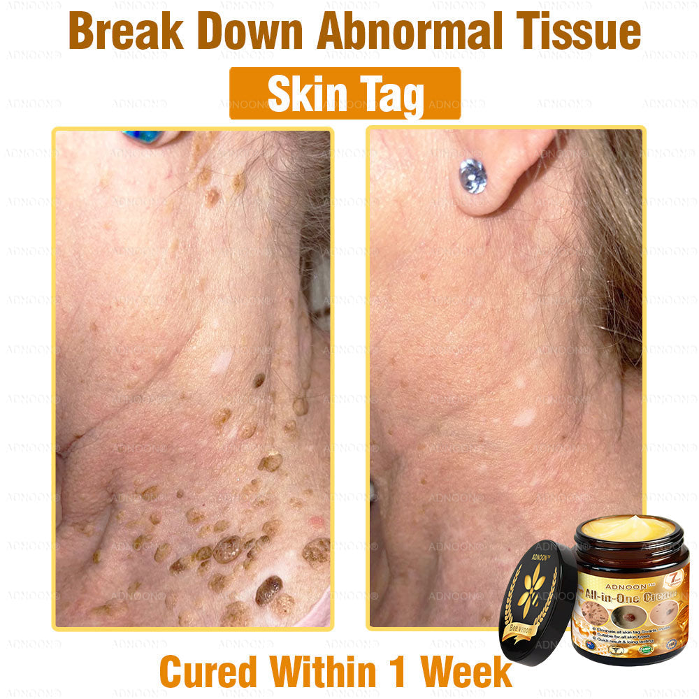 Official Store✅ADNOON®🌸 Multi-Effect All-in-One Skincare Cream👨⚕️ Certified by The Australasian College of Dermatologists (ACD) (Treating Skin Cancer, Eczema, Acne, Warts, Psoriasis, Wrinkles, Scars, and Varicose Veins)