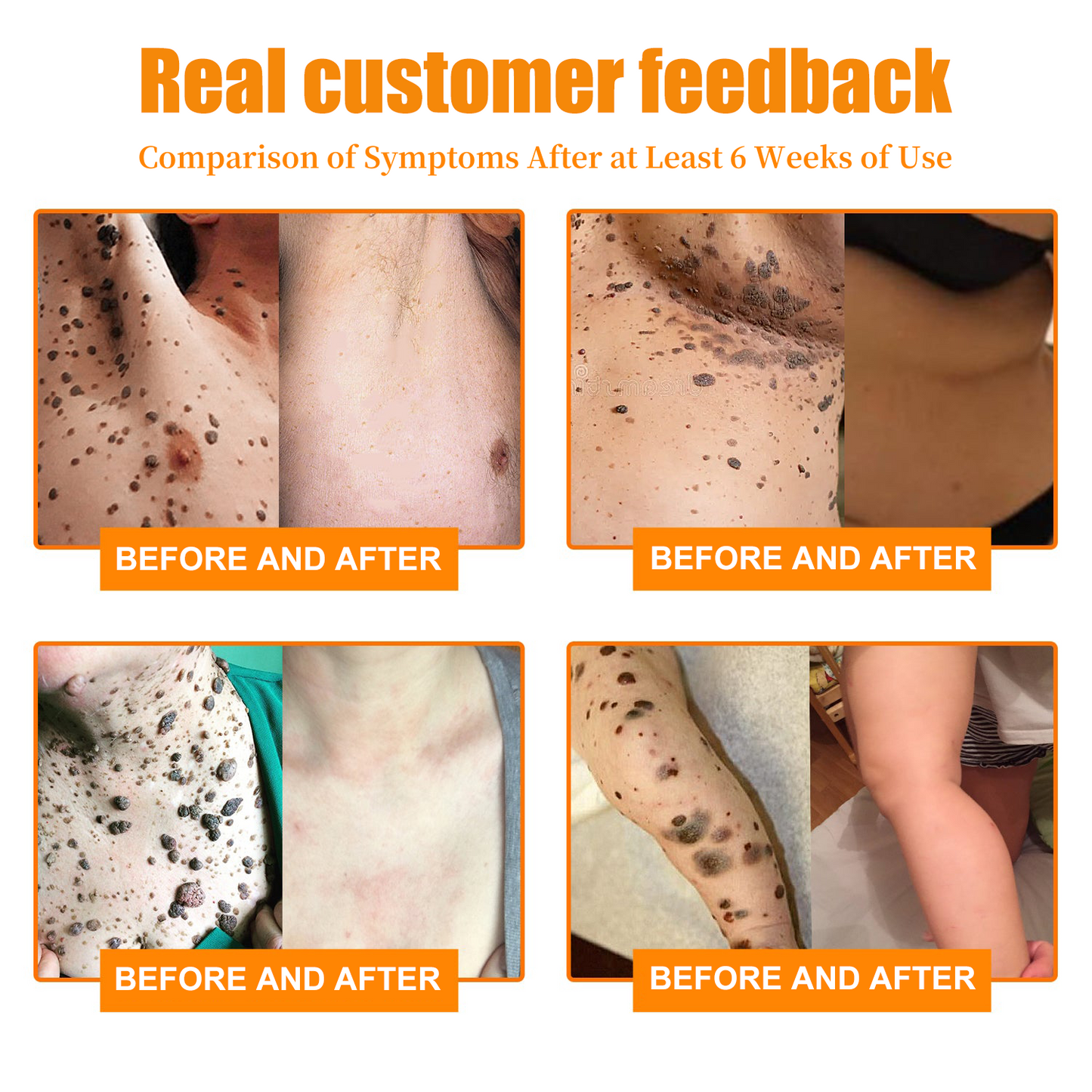 β¨γSkin Specialistγπ«ZZEZHIβ’ Turmeric & Salicylic Skin Treatment Cream π₯ππ’π¦π’πππ ππ’π¦π 7π% ππ
π
π₯(ππ¨ π’π«π«π’ππππ’π¨π§, ππ¨ π©ππ’π§)