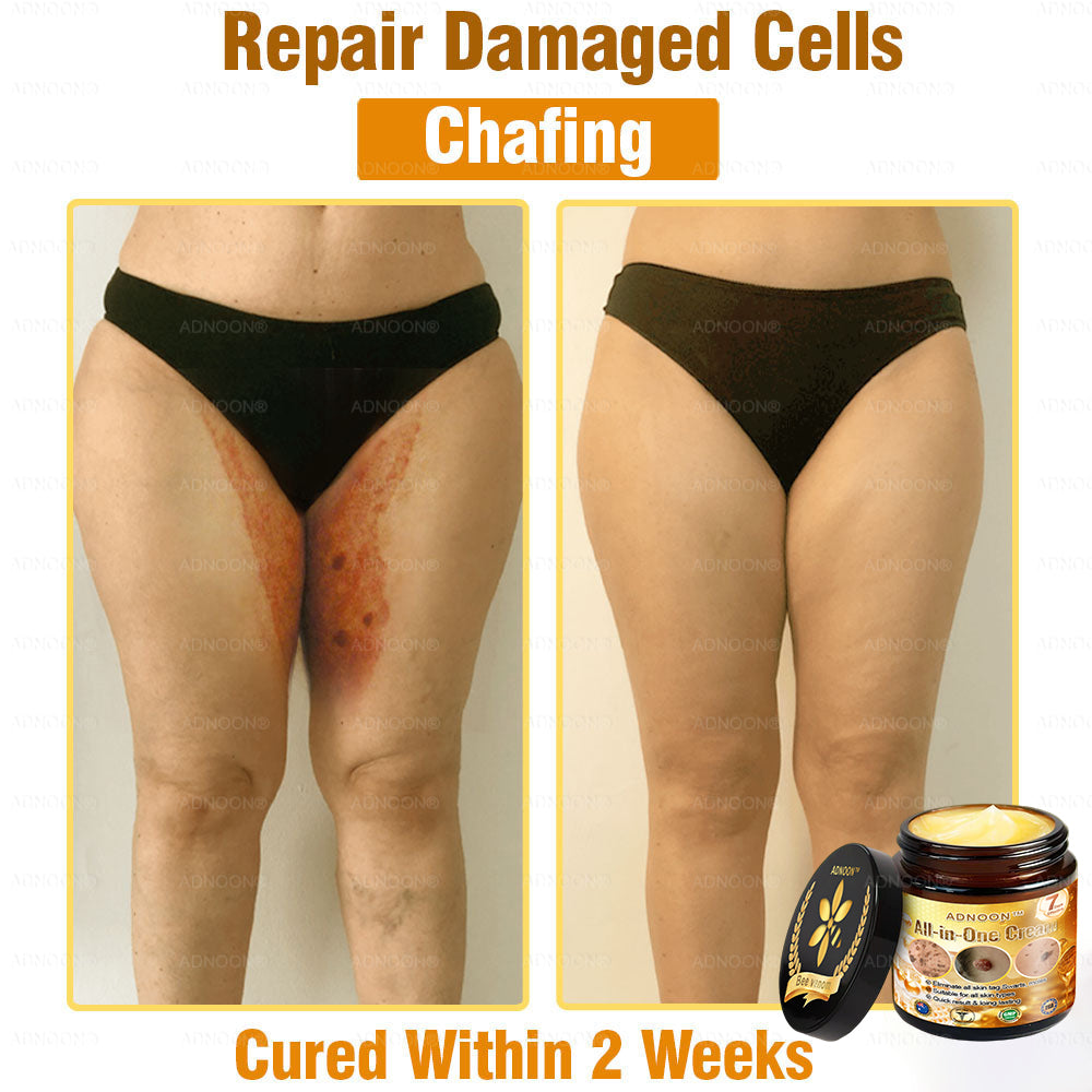 Official Store✅ADNOON®🌸 Multi-Effect All-in-One Skincare Cream👨⚕️ Certified by The Australasian College of Dermatologists (ACD) (Treating Skin Cancer, Eczema, Acne, Warts, Psoriasis, Wrinkles, Scars, and Varicose Veins)