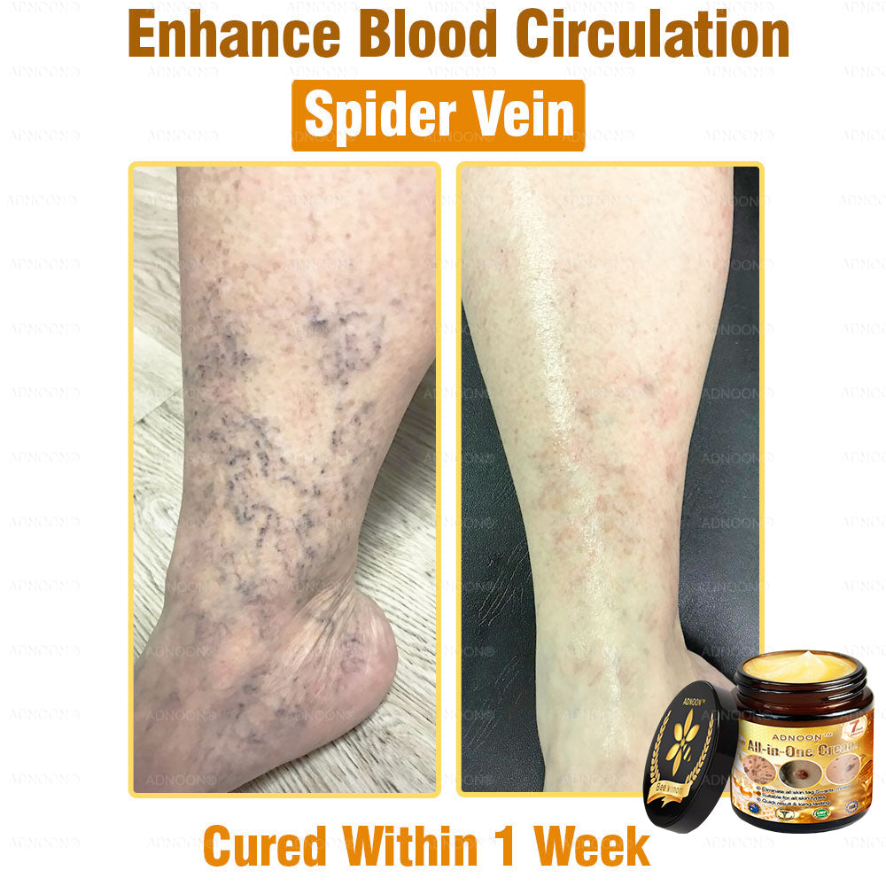 Official Store✅ADNOON®🌸 Multi-Effect All-in-One Skincare Cream👨⚕️ Certified by The Australasian College of Dermatologists (ACD) (Treating Skin Cancer, Eczema, Acne, Warts, Psoriasis, Wrinkles, Scars, and Varicose Veins)