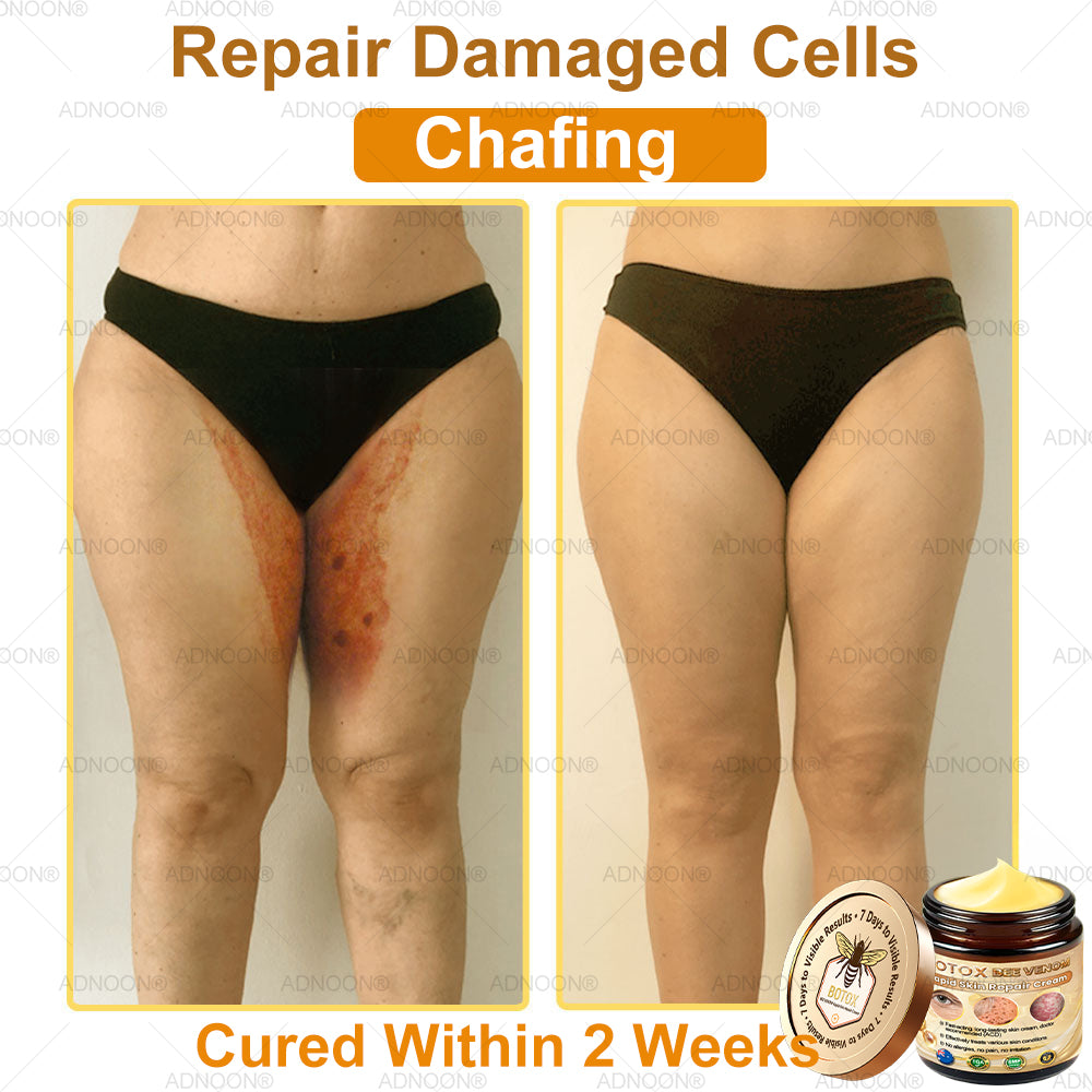 Mayo Clinic Official: 🐝ADNOON®Botox Skin Treatment Cream Anti-aging, Hydrating, Skin Repair, Even Tone, Acne and Dark Spot Treatment, Wart and Mole Removal, Psoriasis Relief🧑⚕️