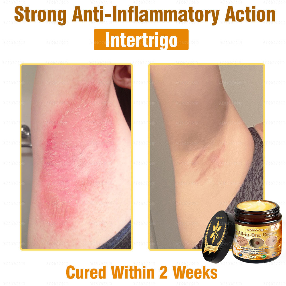 Official Store✅ADNOON®🌸 Multi-Effect All-in-One Skincare Cream👨⚕️ Certified by The Australasian College of Dermatologists (ACD) (Treating Skin Cancer, Eczema, Acne, Warts, Psoriasis, Wrinkles, Scars, and Varicose Veins)