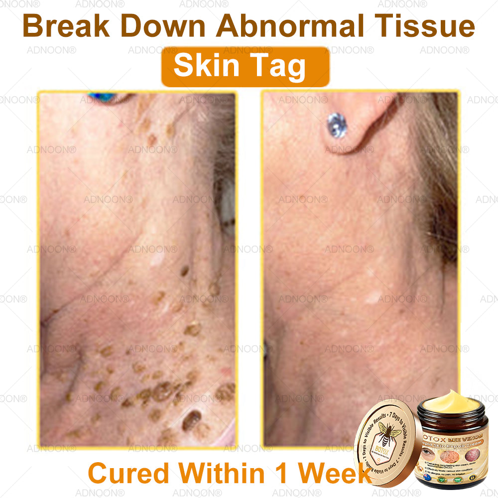 Mayo Clinic Official: 🐝ADNOON®Botox Skin Treatment Cream Anti-aging, Hydrating, Skin Repair, Even Tone, Acne and Dark Spot Treatment, Wart and Mole Removal, Psoriasis Relief🧑⚕️