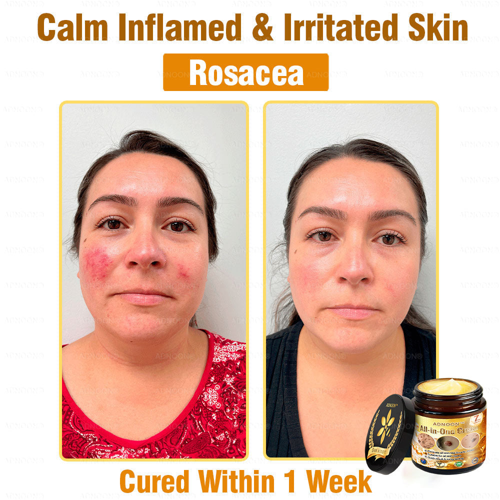 Official Store✅ADNOON®🌸 Multi-Effect All-in-One Skincare Cream👨⚕️ Certified by The Australasian College of Dermatologists (ACD) (Treating Skin Cancer, Eczema, Acne, Warts, Psoriasis, Wrinkles, Scars, and Varicose Veins)