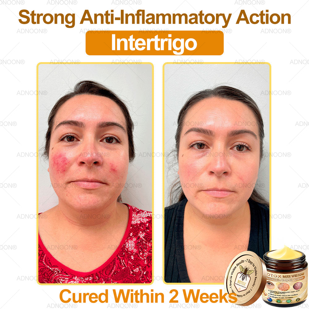 Mayo Clinic Official: 🐝ADNOON®Botox Skin Treatment Cream Anti-aging, Hydrating, Skin Repair, Even Tone, Acne and Dark Spot Treatment, Wart and Mole Removal, Psoriasis Relief🧑⚕️