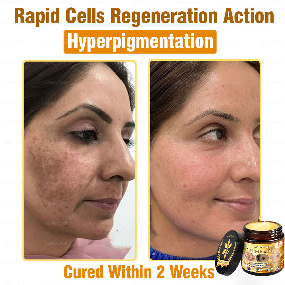 Official Store✅ADNOON®🌸 Multi-Effect All-in-One Skincare Cream👨⚕️ Certified by The Australasian College of Dermatologists (ACD) (Treating Skin Cancer, Eczema, Acne, Warts, Psoriasis, Wrinkles, Scars, and Varicose Veins)