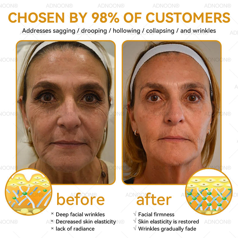 Mayo Clinic Official: 🐝ADNOON®Botox Skin Treatment Cream Anti-aging, Hydrating, Skin Repair, Even Tone, Acne and Dark Spot Treatment, Wart and Mole Removal, Psoriasis Relief🧑⚕️