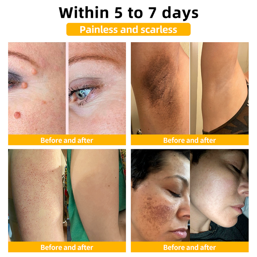 β¨γSkin Specialistγπ«ZZEZHIβ’ Turmeric & Salicylic Skin Treatment Cream π₯ππ’π¦π’πππ ππ’π¦π 7π% ππ
π
π₯(ππ¨ π’π«π«π’ππππ’π¨π§, ππ¨ π©ππ’π§)