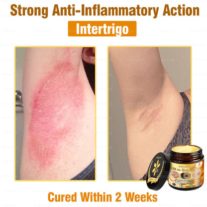 Official Store✅ADNOON®🌸 Multi-Effect All-in-One Skincare Cream👨‍⚕️ Certified by The Australasian College of Dermatologists (ACD) (Treating Skin Cancer, Eczema, Acne, Warts, Psoriasis, Wrinkles, Scars, and Varicose Veins)